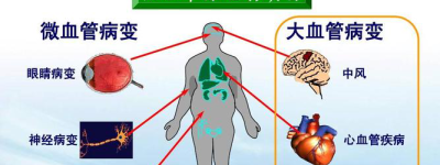 糖尿病新发现最新研究揭示糖尿病与脑部健康的关系