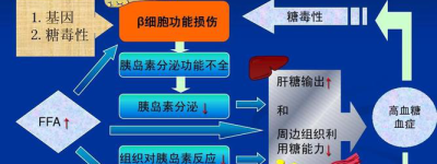 糖尿病最新研究应对新挑战